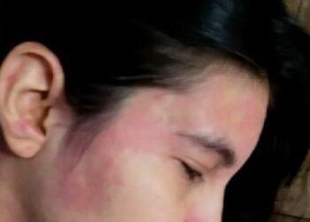 Temporada de Praia: Gerente descobre ‘alergia à água’ após nadar no lago de Palmas